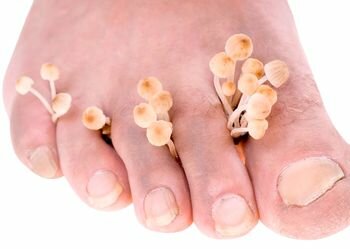 Грибок ногтей на ногах — чем лечить в домашних условиях?